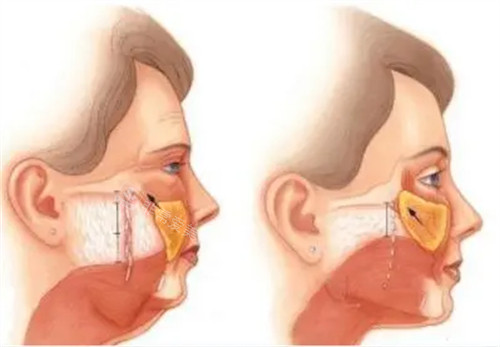 脸部松弛内部图片
