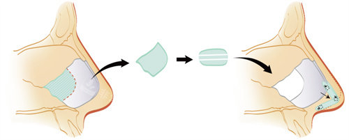 耳軟骨隆鼻手術過程圖