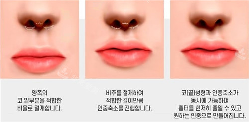 韩国Avant整形外科人中缩短术动画展示图