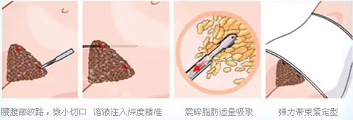 推荐合肥姬延林医生做吸脂，开心加倍！