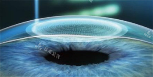 近视手术示意图 近视手术示意图