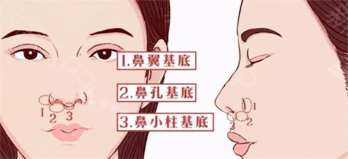 鼻翼基底，鼻孔基底，鼻小柱基底圖片