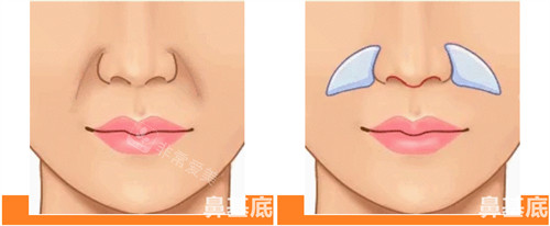 鼻基底凹陷图片