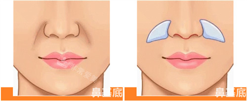 鼻基底凹陷圖片