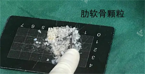 肋軟骨顆粒圖片