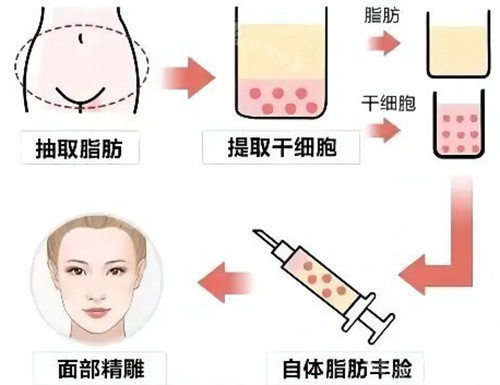 自體脂肪填充過(guò)程圖片 自體脂肪填充過(guò)程圖片