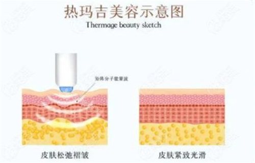 热玛吉示意图