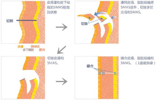 皮肤切口图片