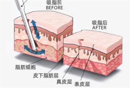 吸脂前后脂肪層變化圖 吸脂前后脂肪層變化圖
