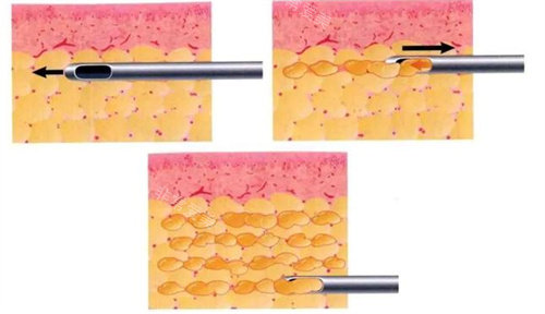 吸脂过程展示图