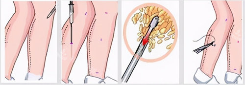 小腿吸脂手术流程图