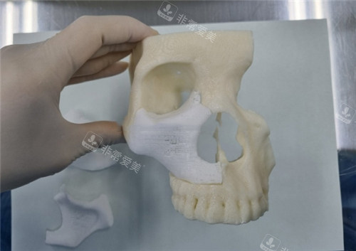 韩国欧佩拉整形外科补骨材料展示