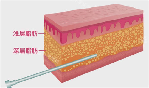 西安画美整形浅层脂肪与深层脂肪图