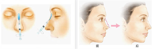 隆鼻術(shù)前術(shù)后對(duì)比圖 隆鼻術(shù)前術(shù)后對(duì)比圖