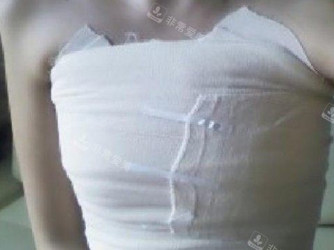 隆胸手术后照片 隆胸手术后照片