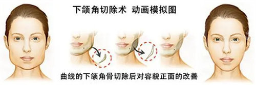 下頜角手術(shù)流程圖 下頜角手術(shù)流程圖