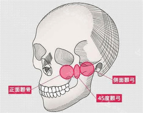顴弓位置示意圖 顴弓位置示意圖