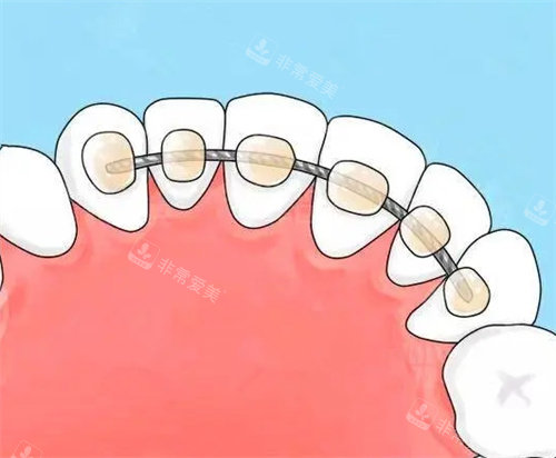 牙齿矫正动画图 牙齿矫正动画图