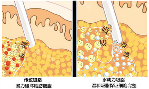 水动力吸脂图