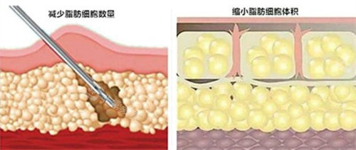 吸脂示意图