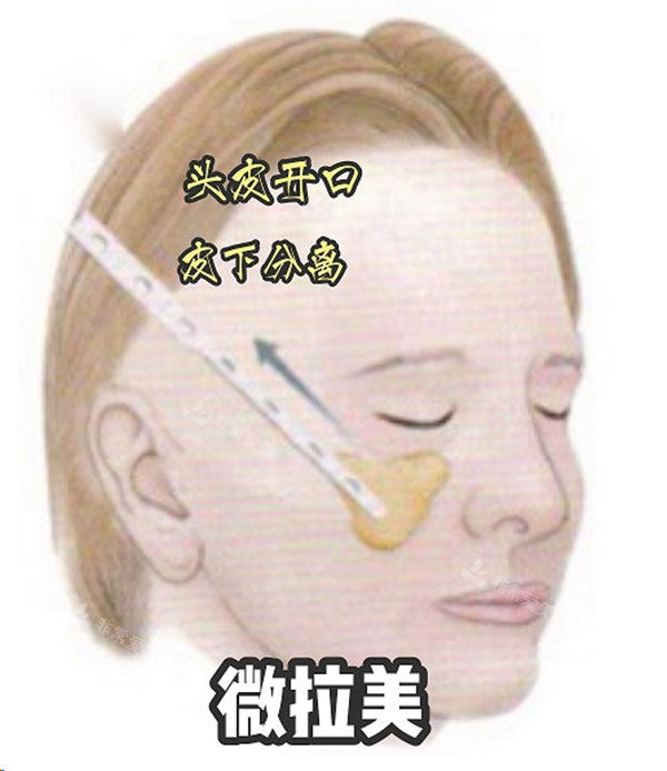 微拉美面部切口位置图片