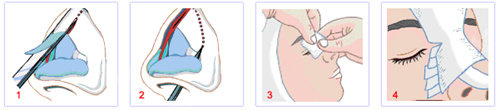 隆鼻手術(shù)流程圖