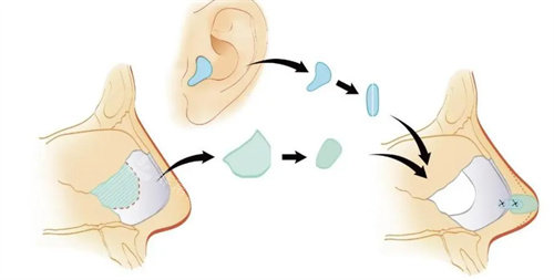 耳軟骨隆鼻動(dòng)畫圖