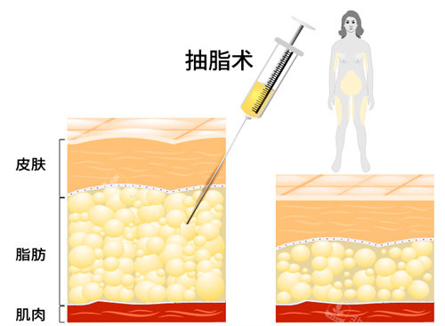 抽脂手術(shù)前后脂肪層對比圖 抽脂手術(shù)前后脂肪層對比圖