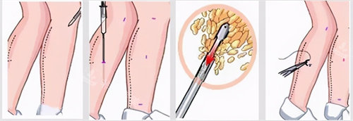 小腿吸脂手术流程图