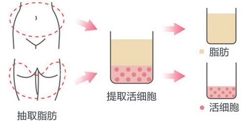 脂肪填充 脂肪填充