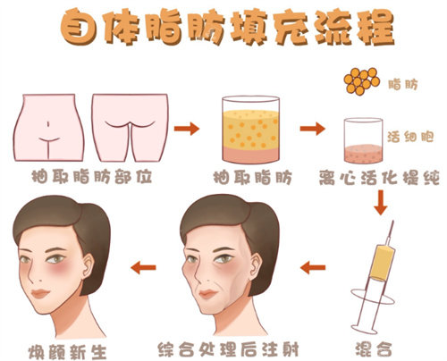 自體脂肪填充 自體脂肪填充