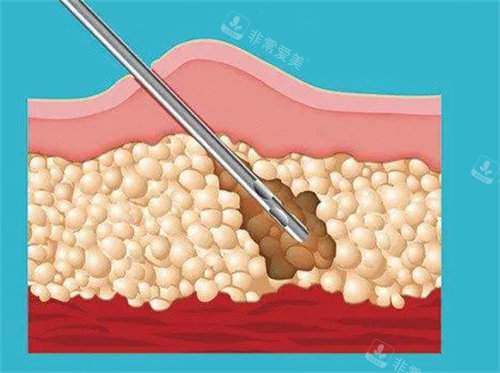 吸脂示意图