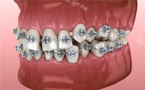 牙齿矫正模型图示