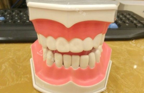牙齿模具图 牙齿模具图