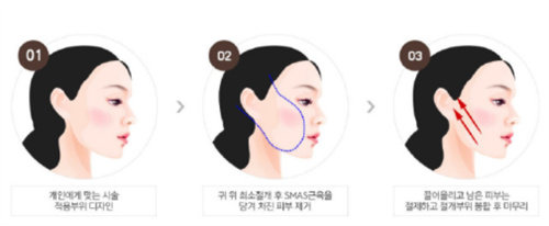 韓國必當(dāng)歸整形醫(yī)院拉皮手術(shù)流程圖
