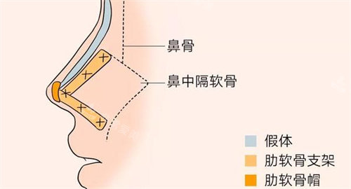 肋軟骨隆鼻動畫圖