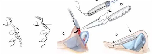 肋軟骨隆鼻手術(shù)過程圖