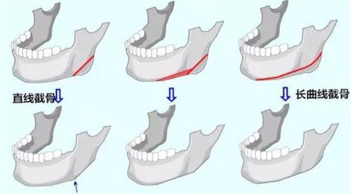 长曲线截骨与直线截骨对比图