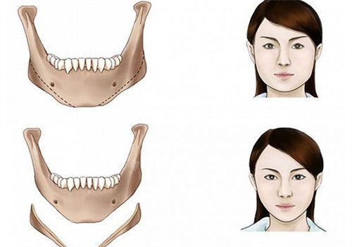 下颌角手术对比图