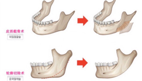下颌角截骨手术动画图