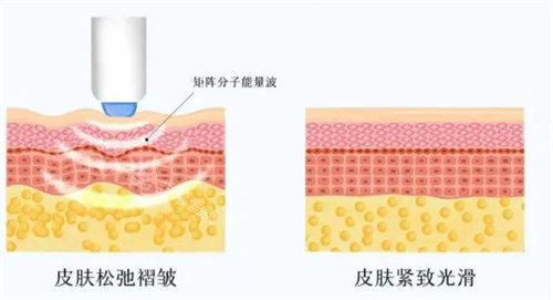 熱瑪吉美容示意圖 熱瑪吉美容示意圖
