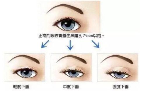 韩国大眼睛整形外科做眼整形巨好，尤其是眼睑下垂！