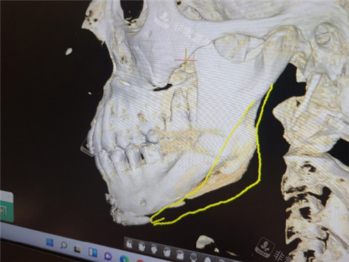欧佩拉整形下颌角补骨CT图