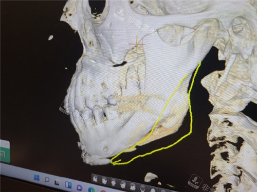 歐佩拉整形下頜角補骨CT圖