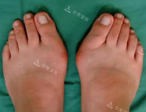 大脚骨畸形外突照片 大脚骨畸形外突照片