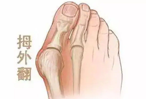 拇外翻照片 拇外翻照片