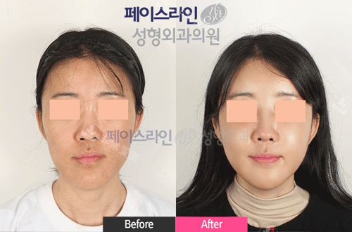 韩国菲斯莱茵整形双颚手术图片