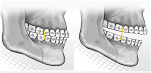 双颚手术后的牙齿矫正