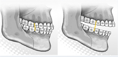 雙顎手術后的牙齒矯正