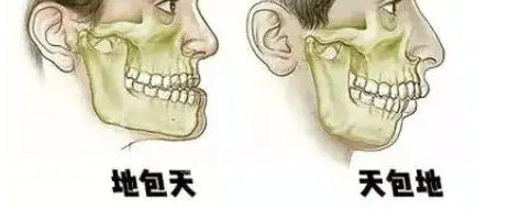 地包天和天包地的牙齒表現(xiàn)圖 地包天和天包地的牙齒表現(xiàn)圖